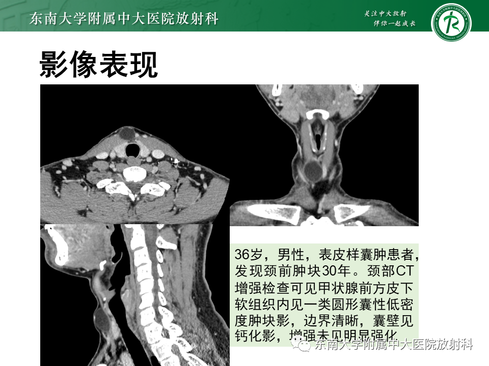 影像PPT - 【PPT】甲状舌管囊肿-24