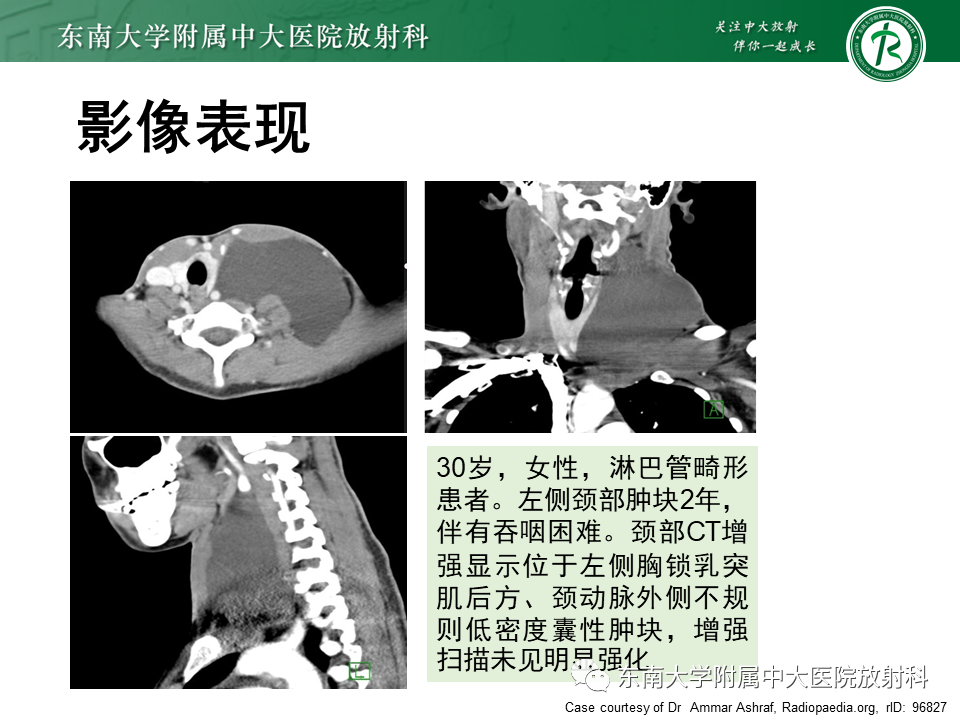 影像PPT - 【PPT】甲状舌管囊肿-21