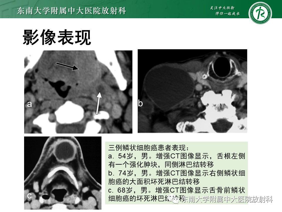 影像PPT - 【PPT】甲状舌管囊肿-29