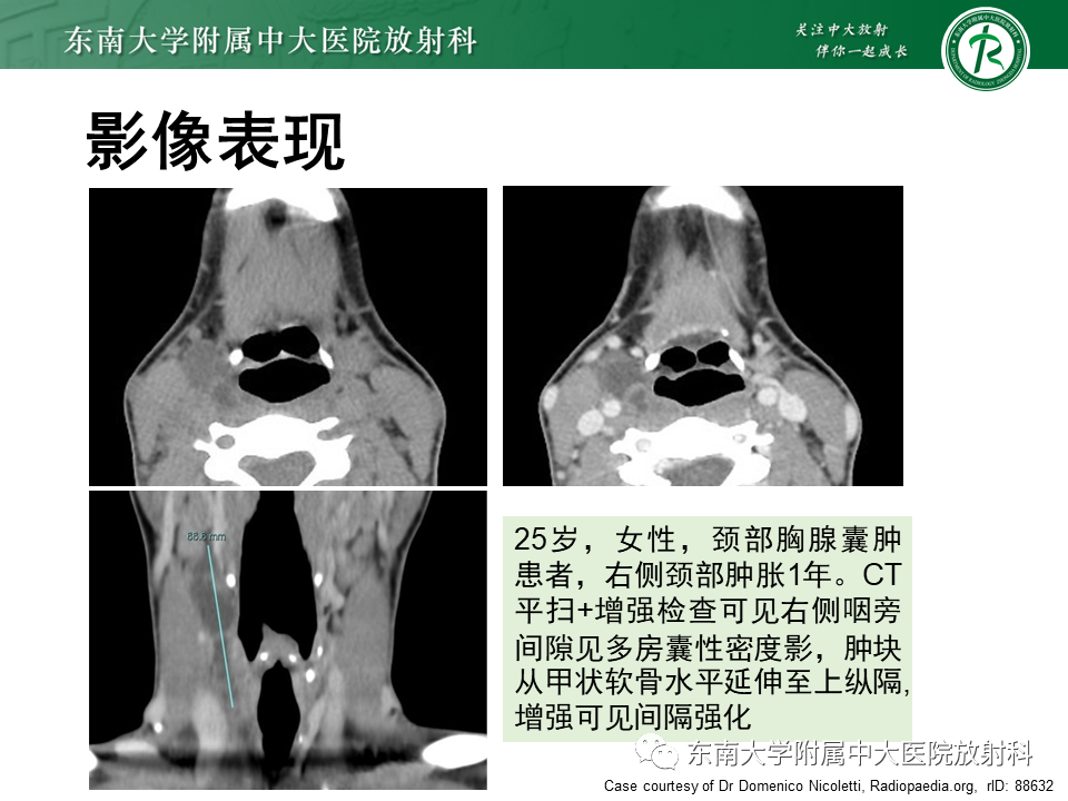 影像PPT - 【PPT】甲状舌管囊肿-27