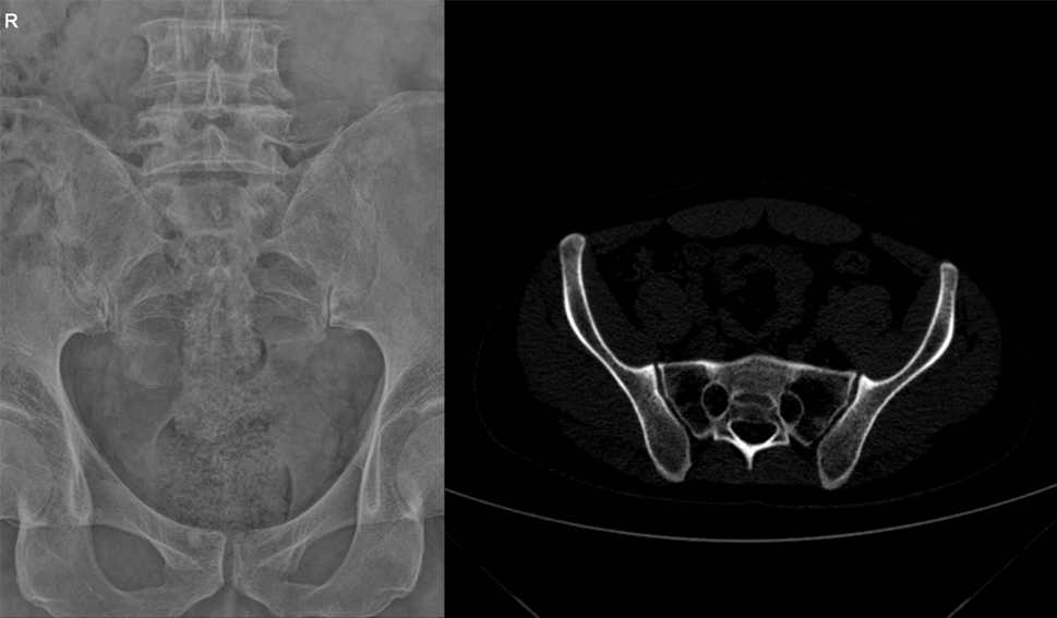 影像PPT - 早期强直性脊柱炎如何诊断?骶髂关节 MRI 应该这么看-5 影像PPT - 早期强直性脊柱炎如何诊断?骶髂关节 MRI 应该这么看-5