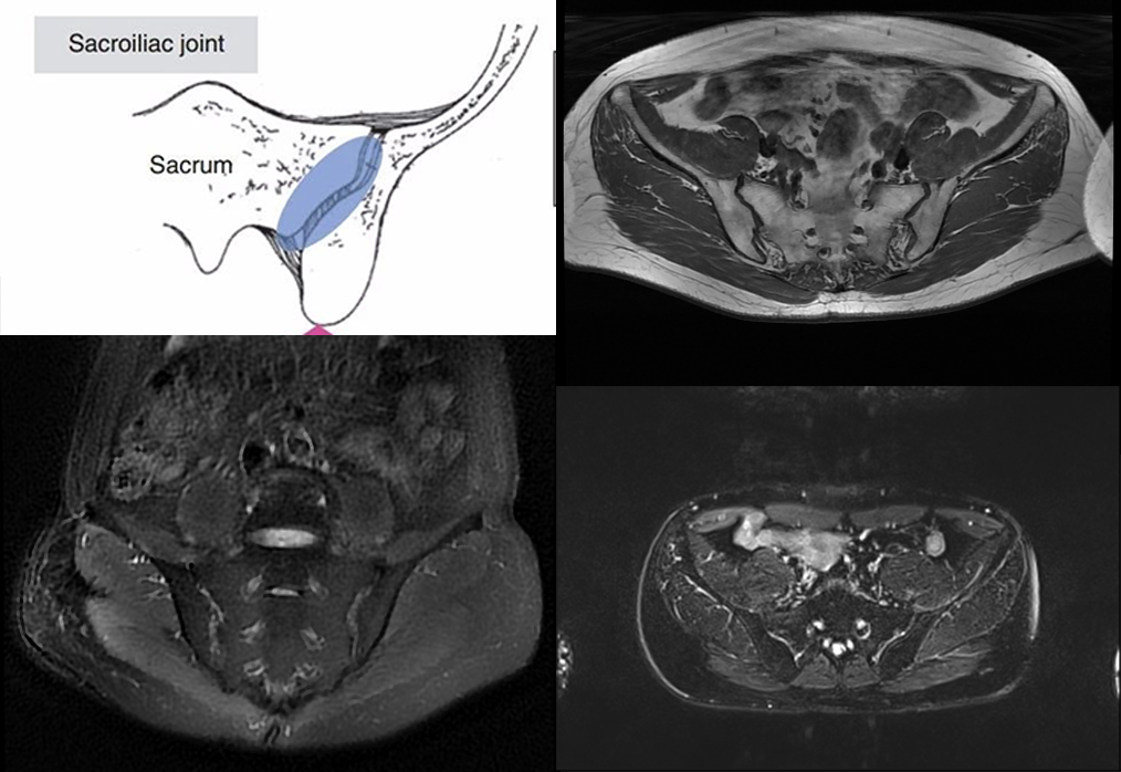影像PPT - 早期强直性脊柱炎如何诊断?骶髂关节 MRI 应该这么看-3 影像PPT - 早期强直性脊柱炎如何诊断?骶髂关节 MRI 应该这么看-3
