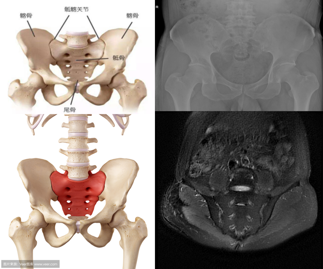 影像PPT - 早期强直性脊柱炎如何诊断?骶髂关节 MRI 应该这么看-1 影像PPT - 早期强直性脊柱炎如何诊断?骶髂关节 MRI 应该这么看-1