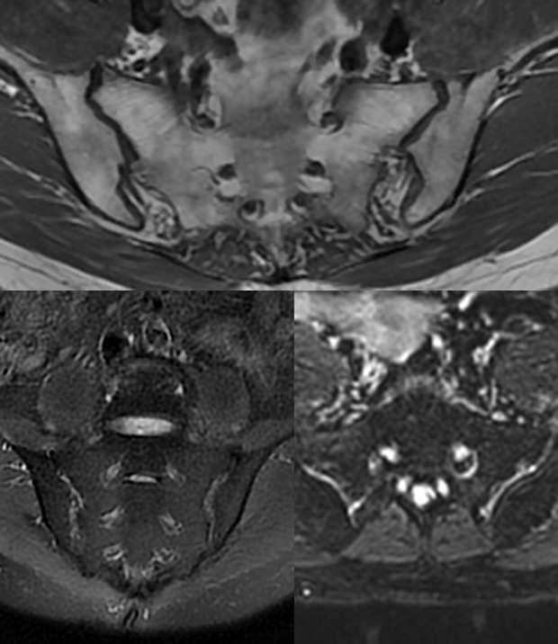 影像PPT - 早期强直性脊柱炎如何诊断?骶髂关节 MRI 应该这么看-6 影像PPT - 早期强直性脊柱炎如何诊断?骶髂关节 MRI 应该这么看-6