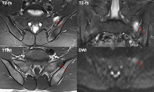 影像PPT - 早期强直性脊柱炎如何诊断?骶髂关节 MRI 应该这么看-7 影像PPT - 早期强直性脊柱炎如何诊断?骶髂关节 MRI 应该这么看-7