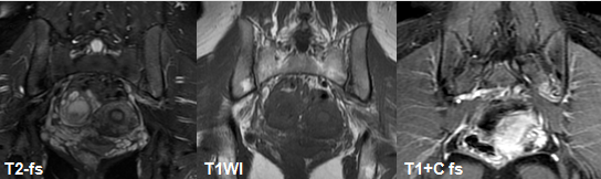 影像PPT - 早期强直性脊柱炎如何诊断?骶髂关节 MRI 应该这么看-11 影像PPT - 早期强直性脊柱炎如何诊断?骶髂关节 MRI 应该这么看-11