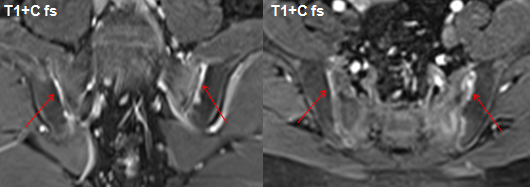 影像PPT - 早期强直性脊柱炎如何诊断?骶髂关节 MRI 应该这么看-9 影像PPT - 早期强直性脊柱炎如何诊断?骶髂关节 MRI 应该这么看-9