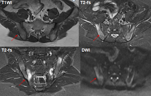 影像PPT - 早期强直性脊柱炎如何诊断?骶髂关节 MRI 应该这么看-14 影像PPT - 早期强直性脊柱炎如何诊断?骶髂关节 MRI 应该这么看-14