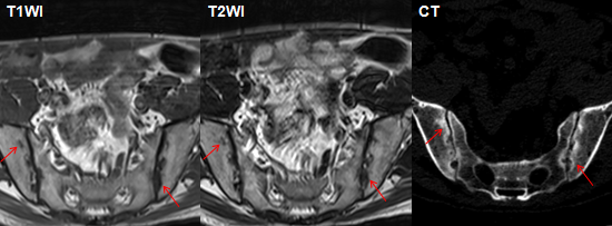 影像PPT - 早期强直性脊柱炎如何诊断?骶髂关节 MRI 应该这么看-16 影像PPT - 早期强直性脊柱炎如何诊断?骶髂关节 MRI 应该这么看-16