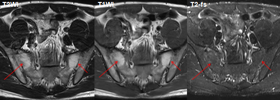 影像PPT - 早期强直性脊柱炎如何诊断?骶髂关节 MRI 应该这么看-18 影像PPT - 早期强直性脊柱炎如何诊断?骶髂关节 MRI 应该这么看-18