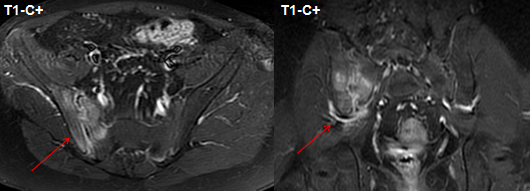影像PPT - 早期强直性脊柱炎如何诊断?骶髂关节 MRI 应该这么看-13 影像PPT - 早期强直性脊柱炎如何诊断?骶髂关节 MRI 应该这么看-13