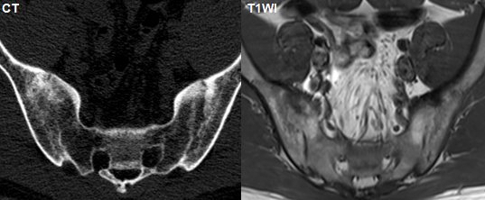 影像PPT - 早期强直性脊柱炎如何诊断?骶髂关节 MRI 应该这么看-19 影像PPT - 早期强直性脊柱炎如何诊断?骶髂关节 MRI 应该这么看-19