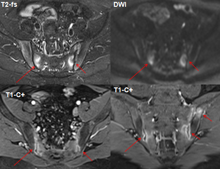影像PPT - 早期强直性脊柱炎如何诊断?骶髂关节 MRI 应该这么看-15 影像PPT - 早期强直性脊柱炎如何诊断?骶髂关节 MRI 应该这么看-15