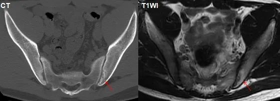 影像PPT - 早期强直性脊柱炎如何诊断?骶髂关节 MRI 应该这么看-17 影像PPT - 早期强直性脊柱炎如何诊断?骶髂关节 MRI 应该这么看-17