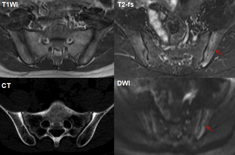 影像PPT - 早期强直性脊柱炎如何诊断?骶髂关节 MRI 应该这么看-21 影像PPT - 早期强直性脊柱炎如何诊断?骶髂关节 MRI 应该这么看-21