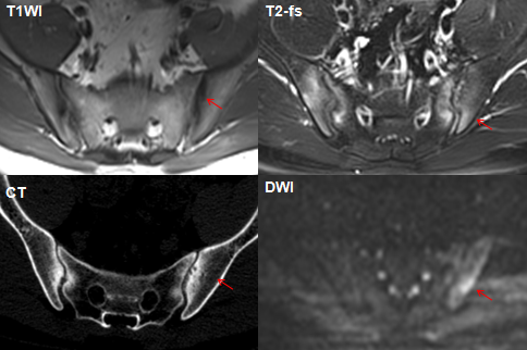 影像PPT - 早期强直性脊柱炎如何诊断?骶髂关节 MRI 应该这么看-22 影像PPT - 早期强直性脊柱炎如何诊断?骶髂关节 MRI 应该这么看-22