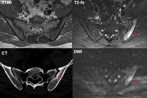 影像PPT - 早期强直性脊柱炎如何诊断?骶髂关节 MRI 应该这么看-23 影像PPT - 早期强直性脊柱炎如何诊断?骶髂关节 MRI 应该这么看-23