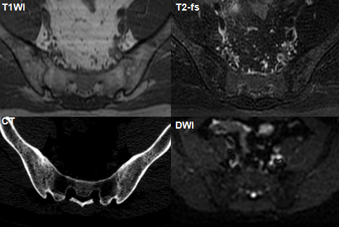 影像PPT - 早期强直性脊柱炎如何诊断?骶髂关节 MRI 应该这么看-24 影像PPT - 早期强直性脊柱炎如何诊断?骶髂关节 MRI 应该这么看-24