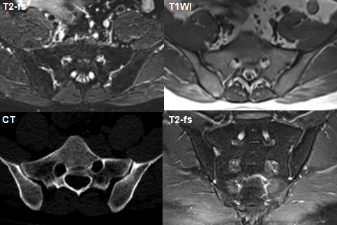 影像PPT - 早期强直性脊柱炎如何诊断?骶髂关节 MRI 应该这么看-20 影像PPT - 早期强直性脊柱炎如何诊断?骶髂关节 MRI 应该这么看-20