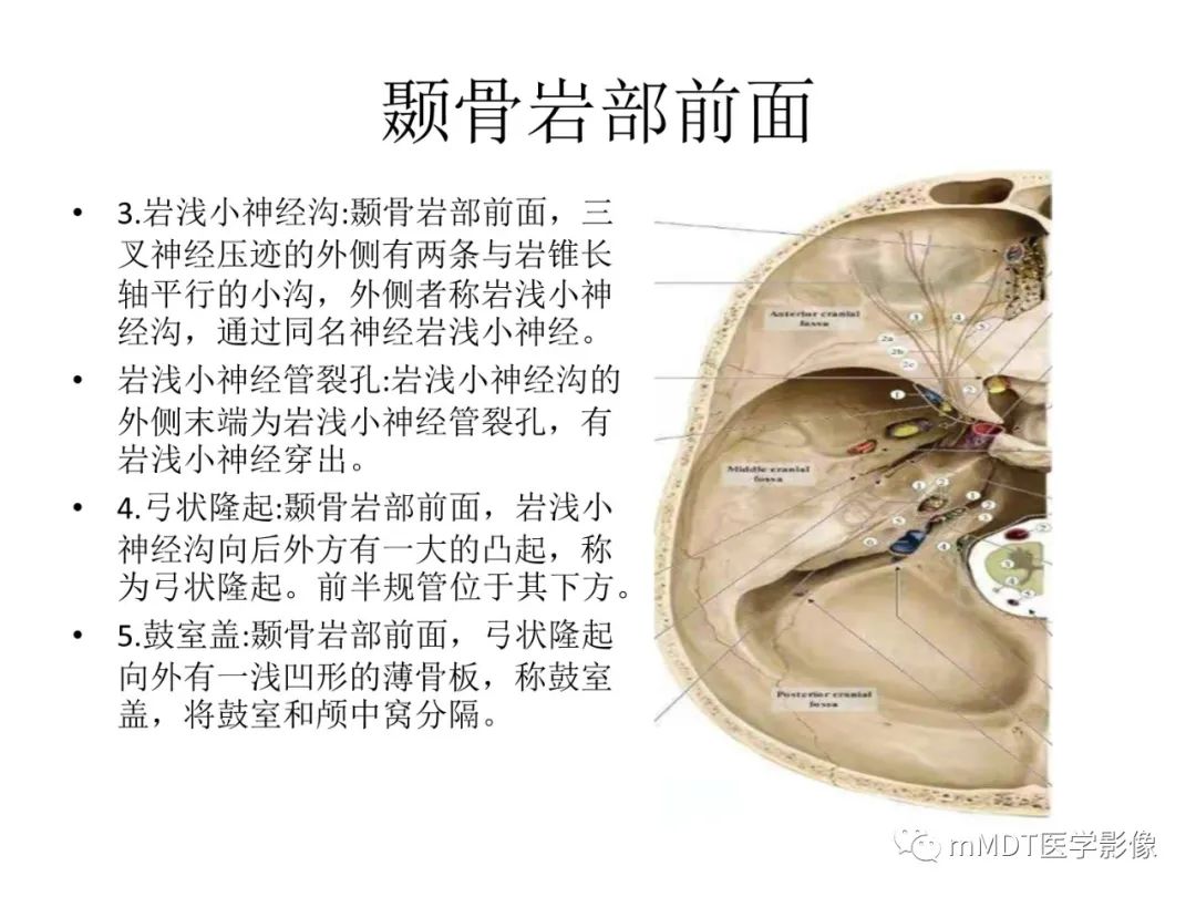 影像PPT - 【病例】岩洞深处藏神仙—穿行在颞骨岩部的神经们-6