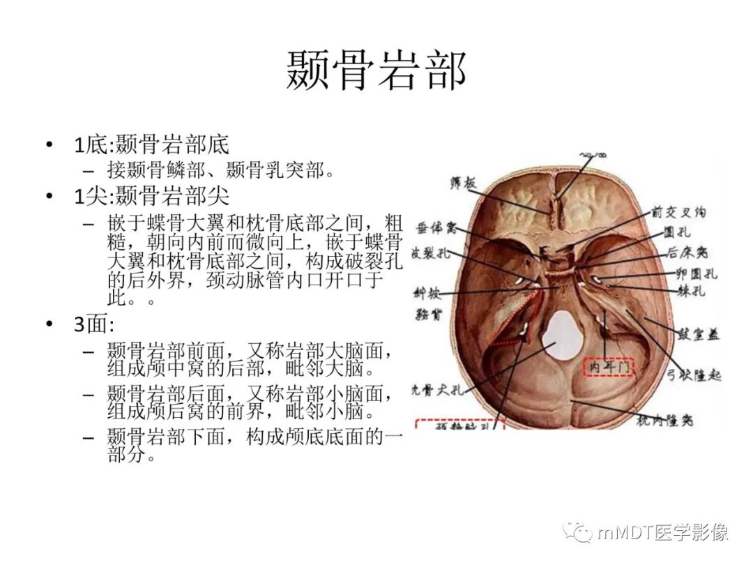 影像PPT - 【病例】岩洞深处藏神仙—穿行在颞骨岩部的神经们-3