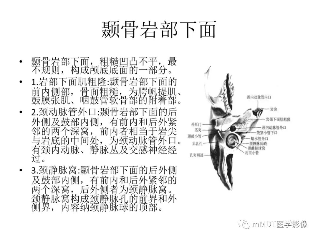 影像PPT - 【病例】岩洞深处藏神仙—穿行在颞骨岩部的神经们-8
