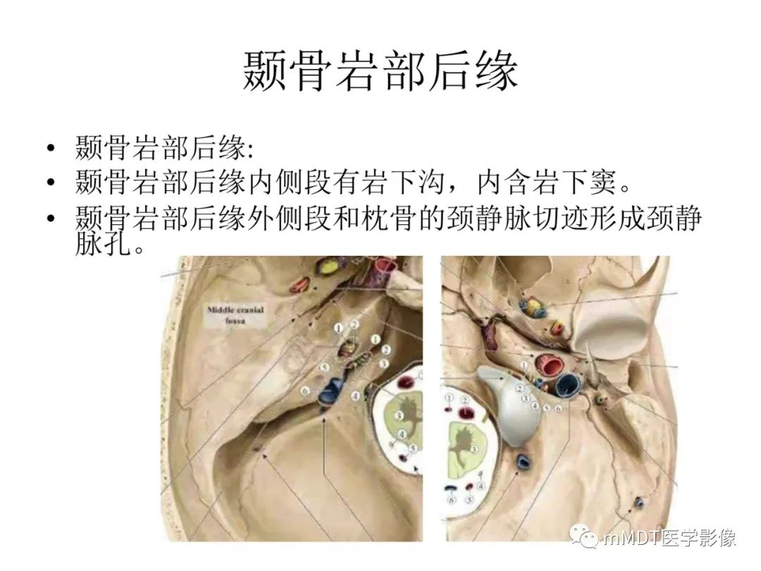 影像PPT - 【病例】岩洞深处藏神仙—穿行在颞骨岩部的神经们-11