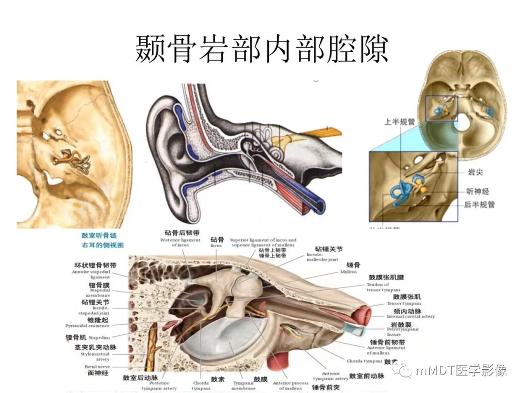影像PPT - 【病例】岩洞深处藏神仙—穿行在颞骨岩部的神经们-13