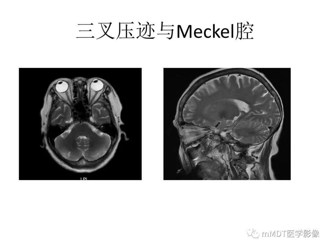 影像PPT - 【病例】岩洞深处藏神仙—穿行在颞骨岩部的神经们-22