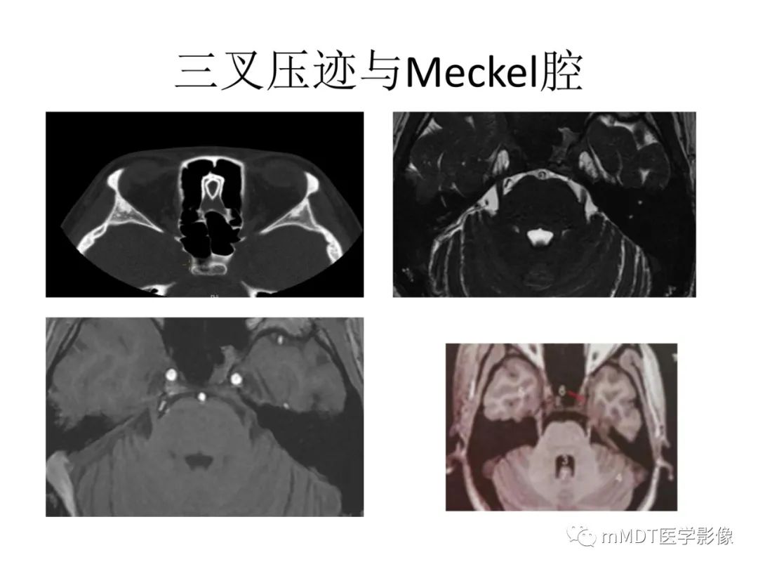 影像PPT - 【病例】岩洞深处藏神仙—穿行在颞骨岩部的神经们-20