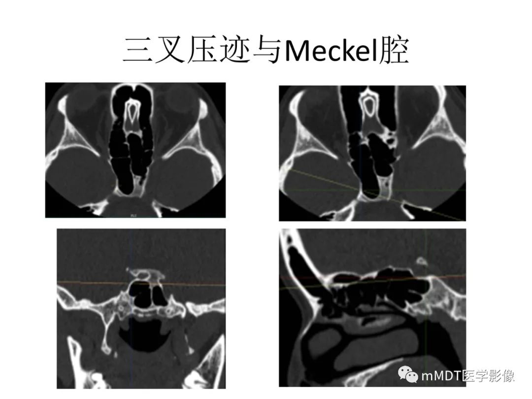 影像PPT - 【病例】岩洞深处藏神仙—穿行在颞骨岩部的神经们-21