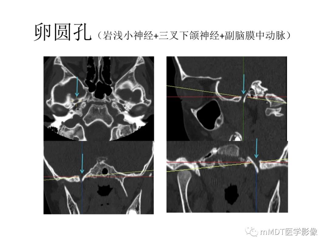 影像PPT - 【病例】岩洞深处藏神仙—穿行在颞骨岩部的神经们-25