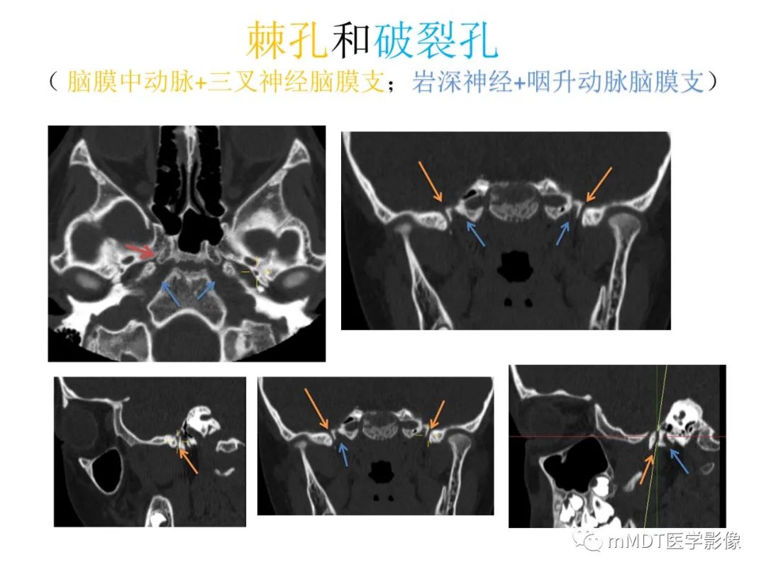 影像PPT - 【病例】岩洞深处藏神仙—穿行在颞骨岩部的神经们-23