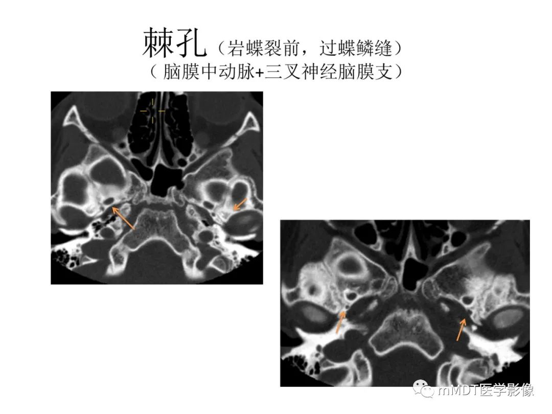 影像PPT - 【病例】岩洞深处藏神仙—穿行在颞骨岩部的神经们-24