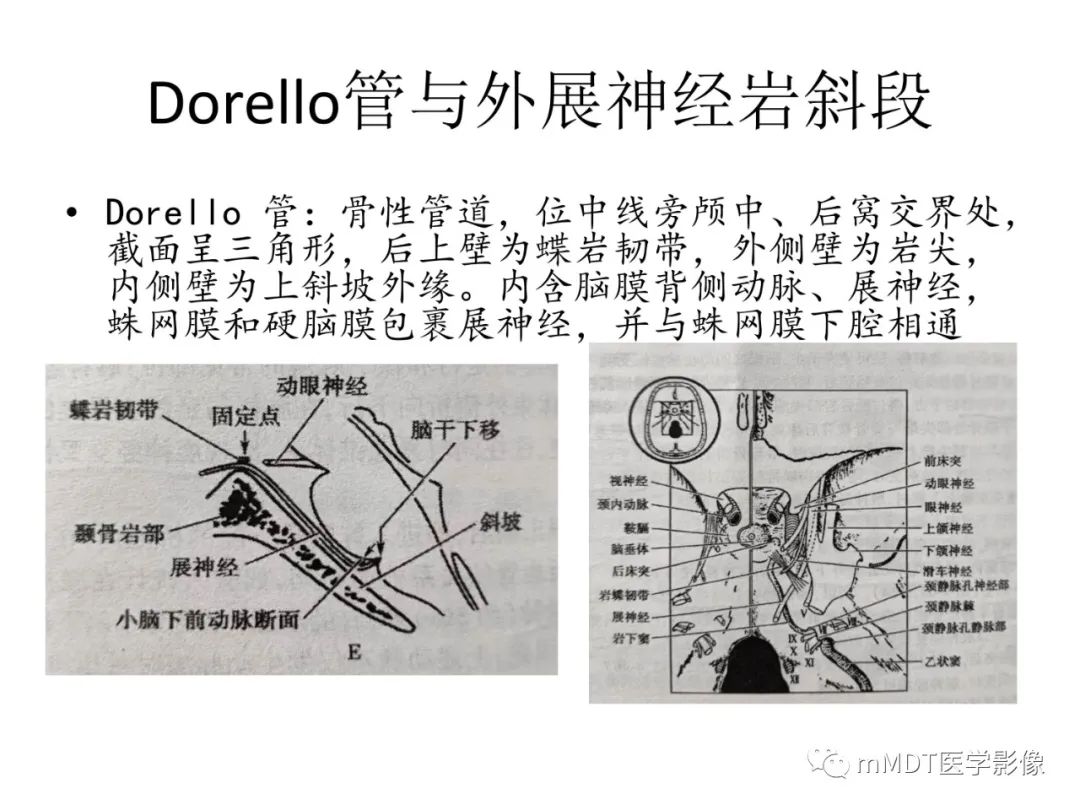 影像PPT - 【病例】岩洞深处藏神仙—穿行在颞骨岩部的神经们-27
