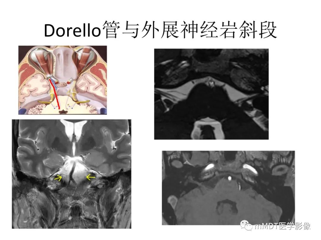 影像PPT - 【病例】岩洞深处藏神仙—穿行在颞骨岩部的神经们-28