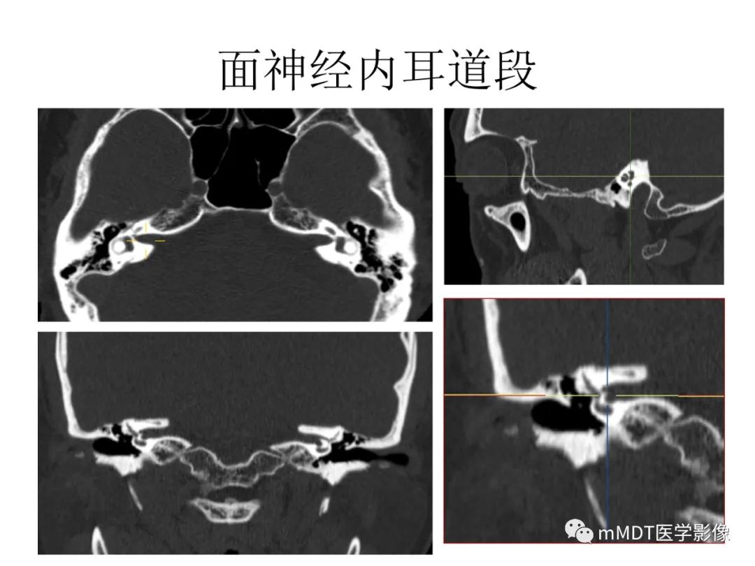 影像PPT - 【病例】岩洞深处藏神仙—穿行在颞骨岩部的神经们-30