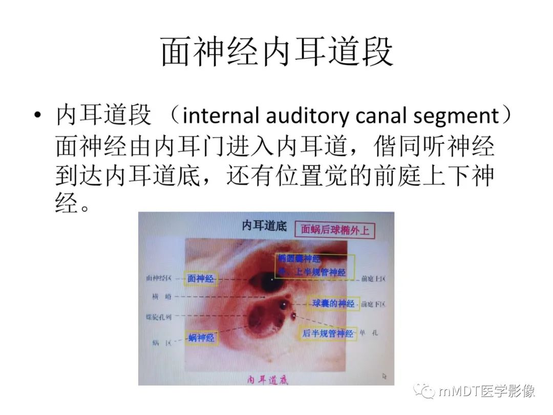 影像PPT - 【病例】岩洞深处藏神仙—穿行在颞骨岩部的神经们-29