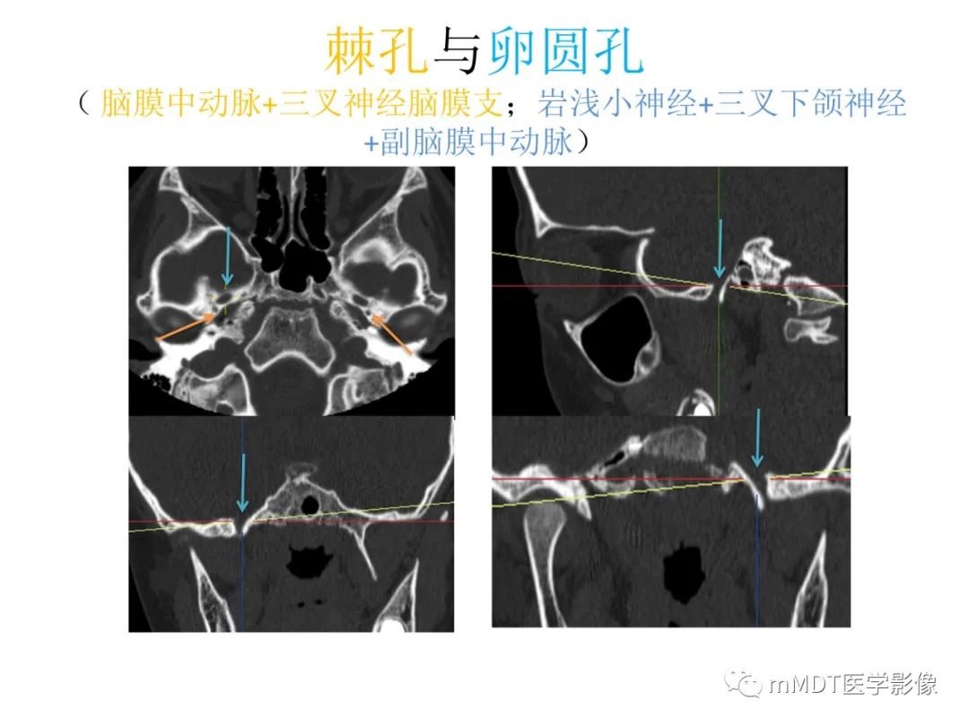 影像PPT - 【病例】岩洞深处藏神仙—穿行在颞骨岩部的神经们-26
