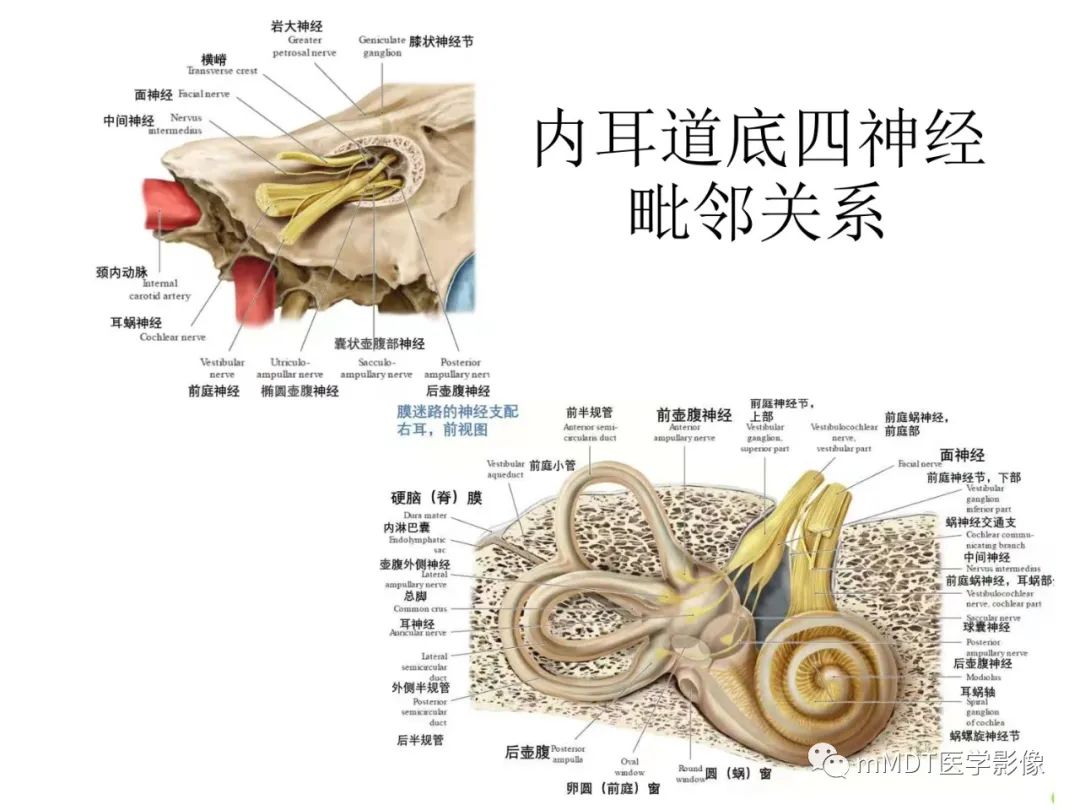 影像PPT - 【病例】岩洞深处藏神仙—穿行在颞骨岩部的神经们-33