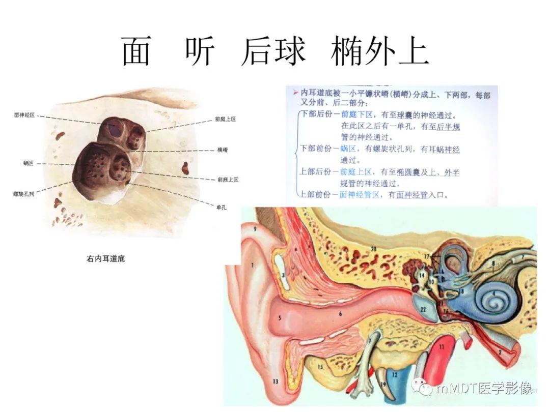 影像PPT - 【病例】岩洞深处藏神仙—穿行在颞骨岩部的神经们-34