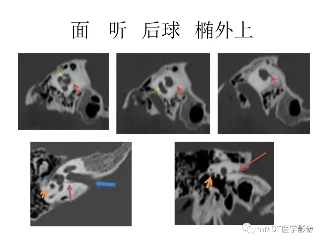 影像PPT - 【病例】岩洞深处藏神仙—穿行在颞骨岩部的神经们-35