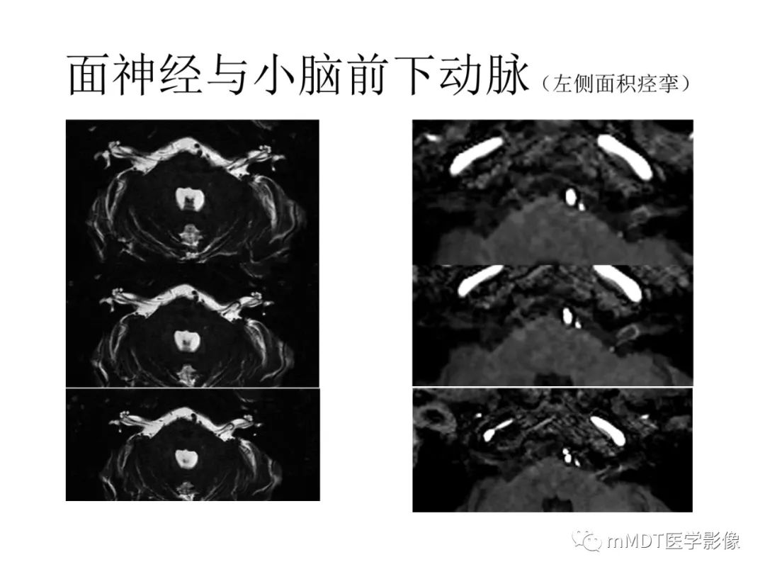 影像PPT - 【病例】岩洞深处藏神仙—穿行在颞骨岩部的神经们-40