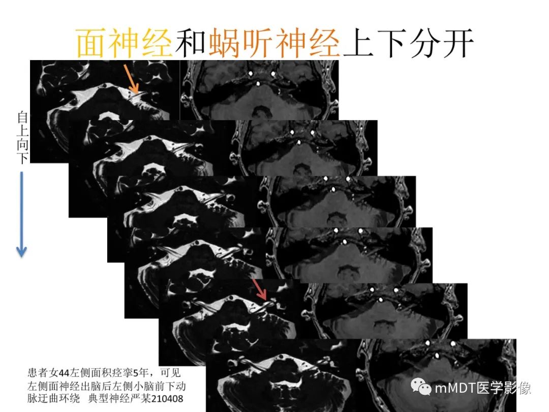 影像PPT - 【病例】岩洞深处藏神仙—穿行在颞骨岩部的神经们-41