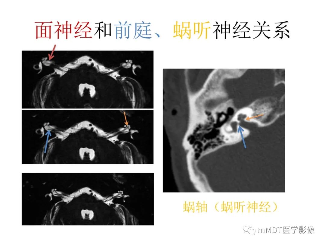 影像PPT - 【病例】岩洞深处藏神仙—穿行在颞骨岩部的神经们-37