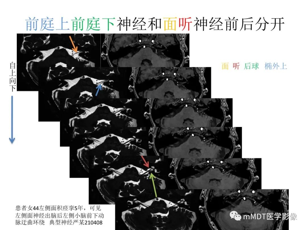 影像PPT - 【病例】岩洞深处藏神仙—穿行在颞骨岩部的神经们-43