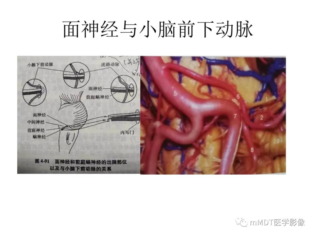 影像PPT - 【病例】岩洞深处藏神仙—穿行在颞骨岩部的神经们-39