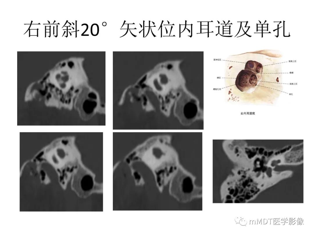 影像PPT - 【病例】岩洞深处藏神仙—穿行在颞骨岩部的神经们-45