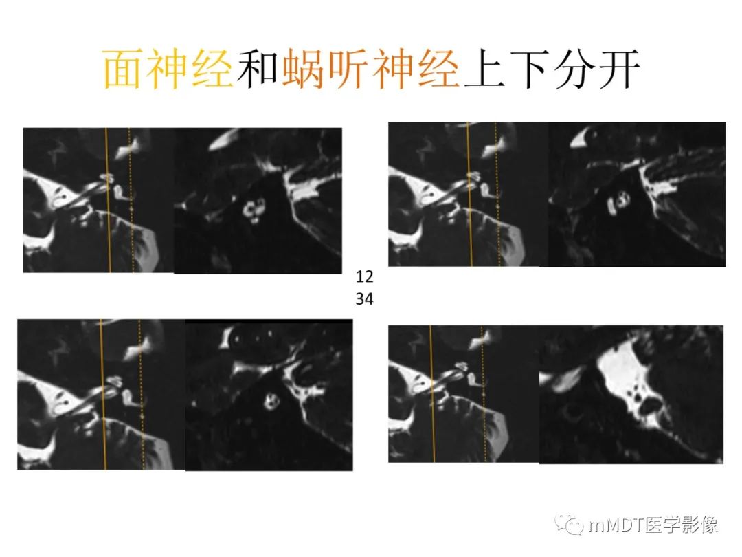 影像PPT - 【病例】岩洞深处藏神仙—穿行在颞骨岩部的神经们-42