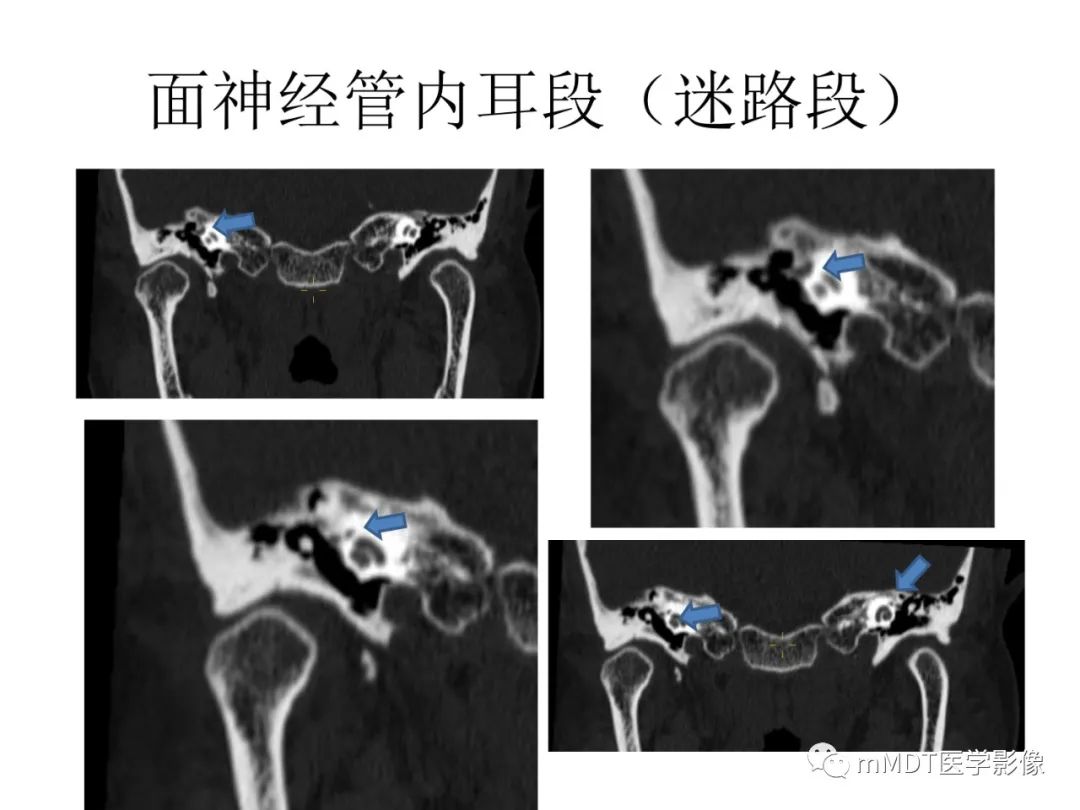 影像PPT - 【病例】岩洞深处藏神仙—穿行在颞骨岩部的神经们-50